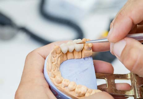 Laboratory technician carefully working on dental bridge in Geneva