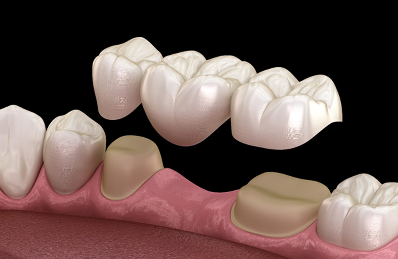 Illustration of traditional, fixed dental bridge in Geneva