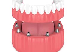 Model of an implant denture