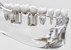Model holding dental implants in Geneva