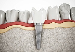 3D rendering of dental implant
