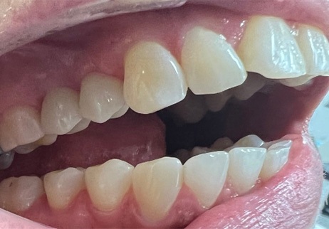 Dental patient smiling after dental implant treatment