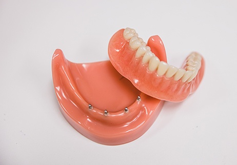 Model of dental implant supported full denture