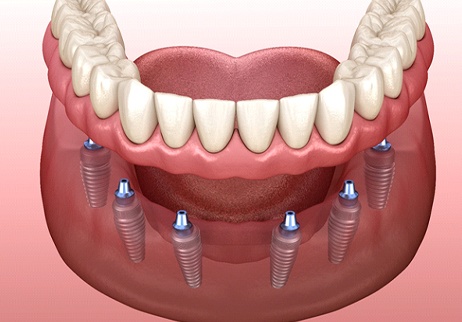 A diagram of an implant denture.