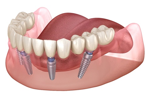 A diagram of an implant denture.