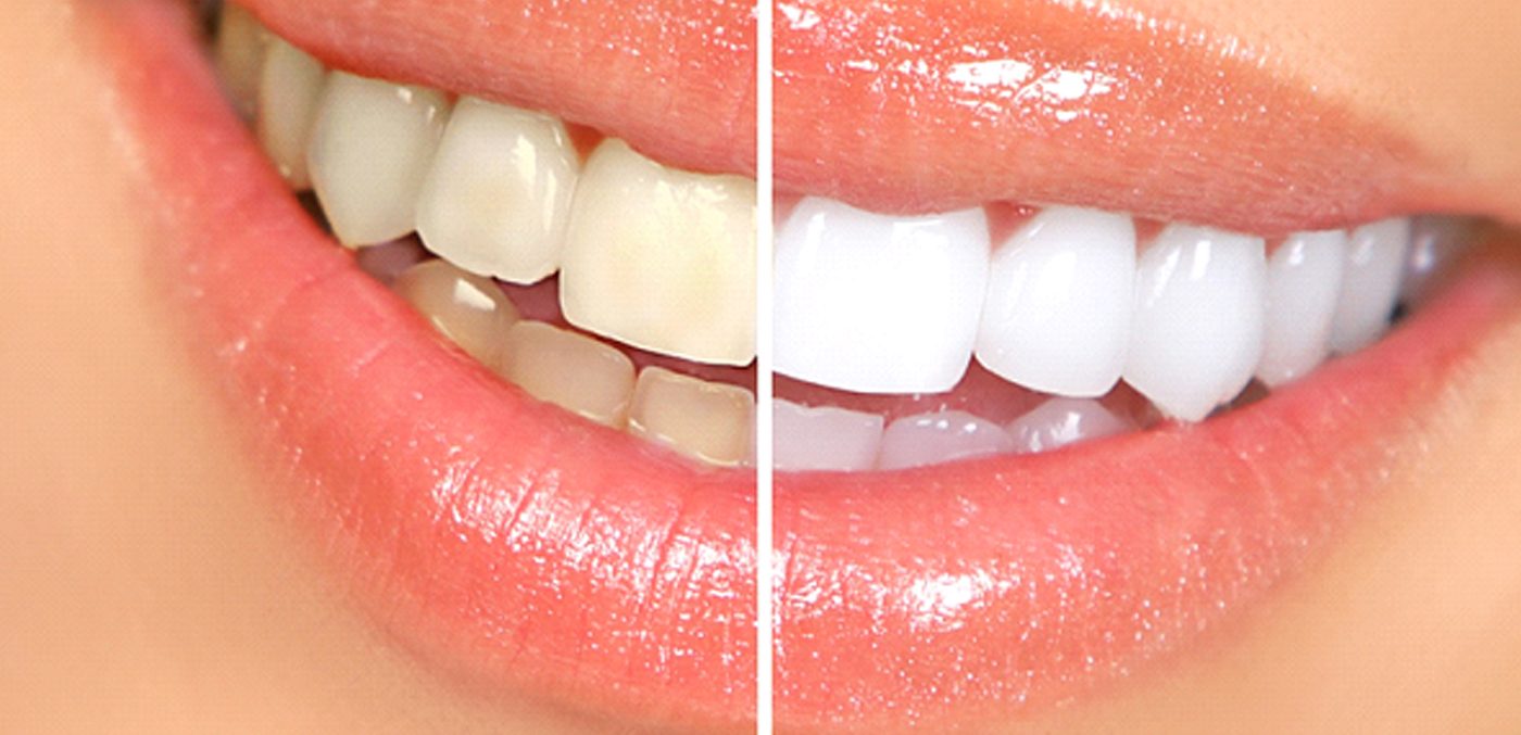 Comparison before and after at-home teeth whitening in Geneva