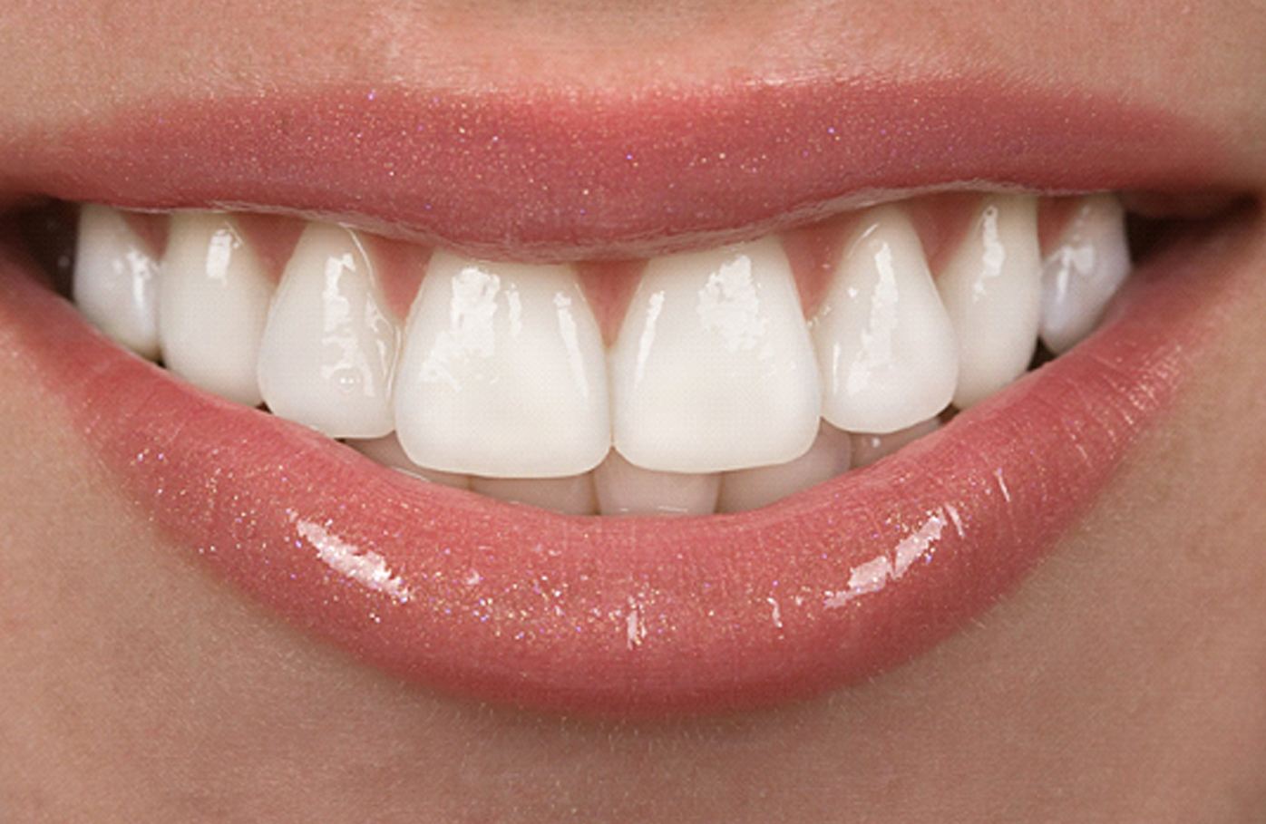 A closeup of a smile with porcelain veneers.