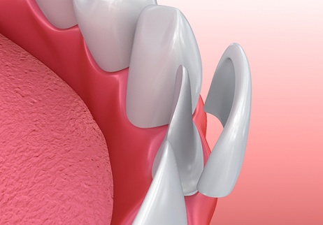 Diagram of a veneer being placed on a tooth.