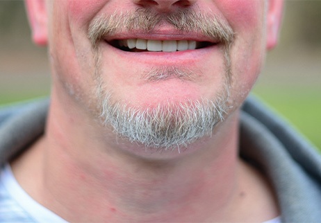 A patient comparing shades of veneers with a dentist.